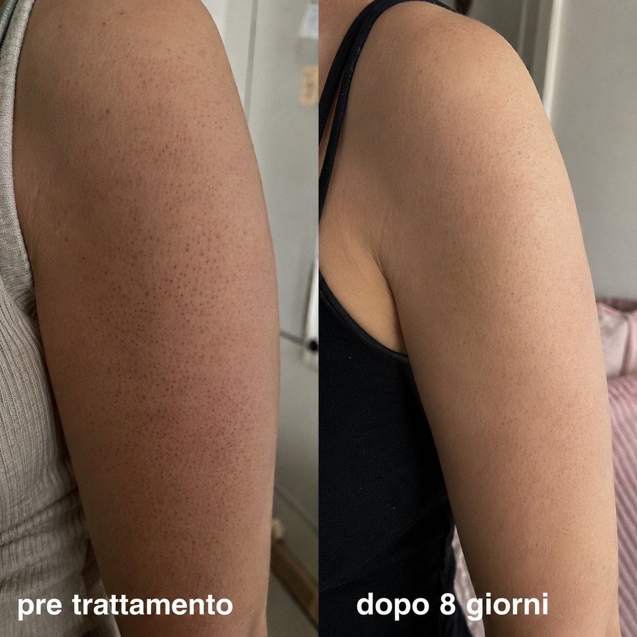 Complesso Multi-Attivo a Triplo Acido per la Cheratosi Pilare
